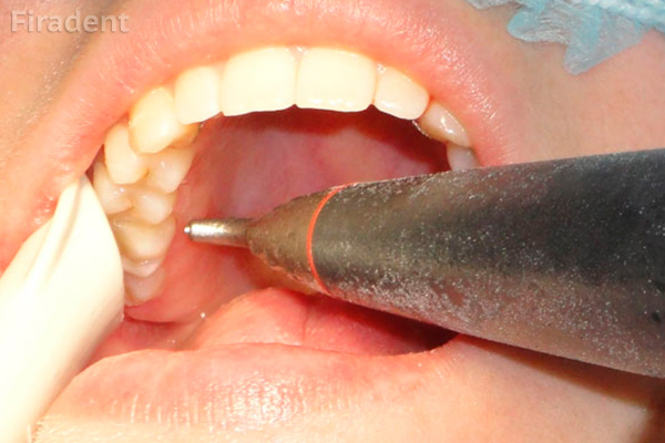 как проходит процедура чистки зубов Air Flow
