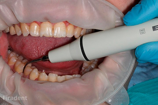 Гигиена зубов и полости рта в стоматологии