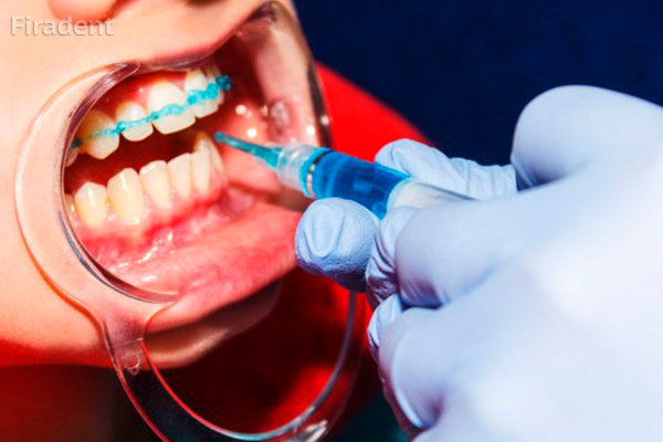 Реминерализация - как процедура гигиены зубов и полости рта