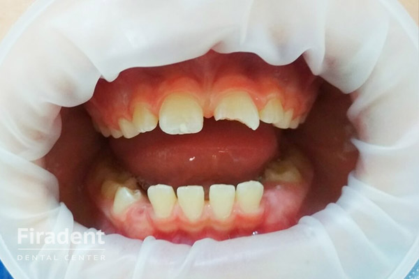 травма зуба