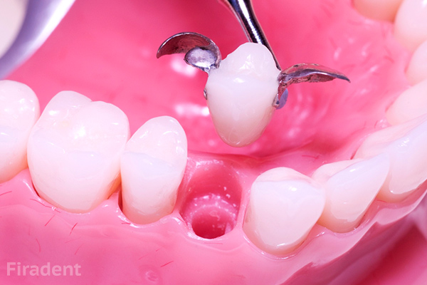 Преимущества имплантации одного зуба перед протезированием этап 2