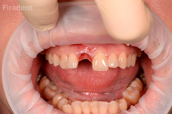 невылеченый кариес причина выпадения зубов