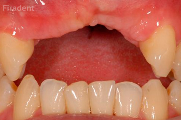 атрофтрование зубной ткани при отсутствии зуба