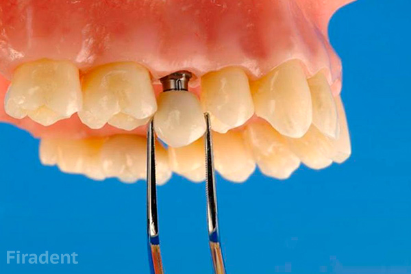 имплантации жевательного верхнего зуба
