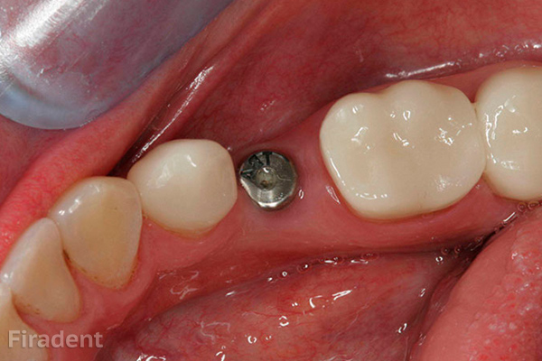 Имплантация нижнего жевательного зуба