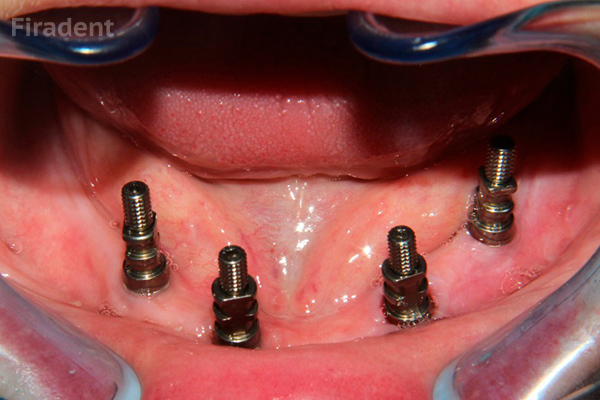 Классическая двухэтапная имплантация зубов нижней челюсти