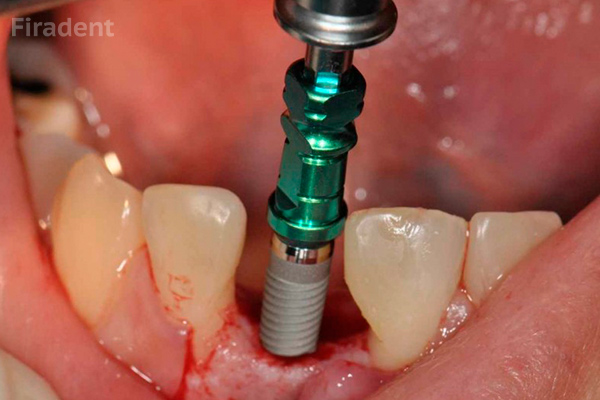 Одноэтапная имплантация нижних зубов