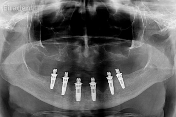 All-on-6 при имплантации нижних зубов