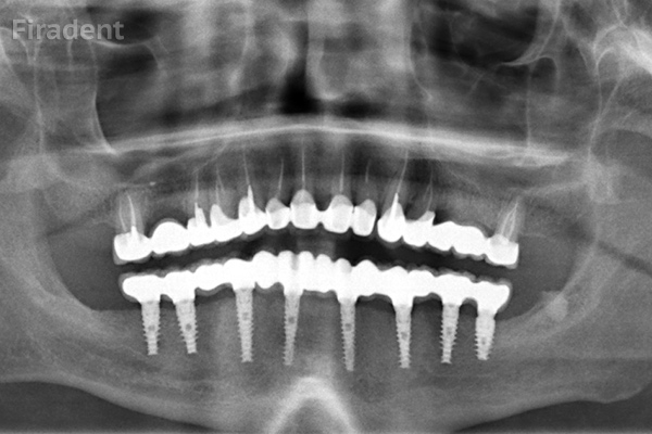 Базальная имплантация зубов нижней челюсти