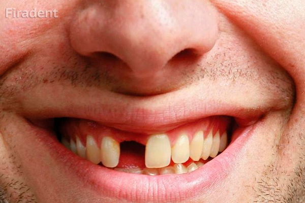 необходимость восстановления потерянного зуба