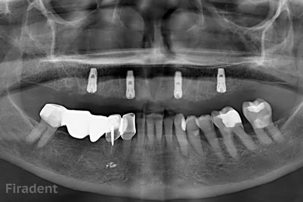 Полная имплантация зубов верхней челюсти all-on-4