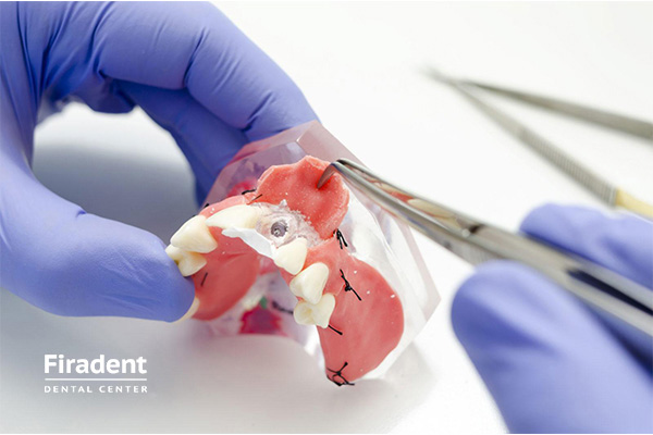 Имплантация зубов под ключ: виды, цены, отзывы