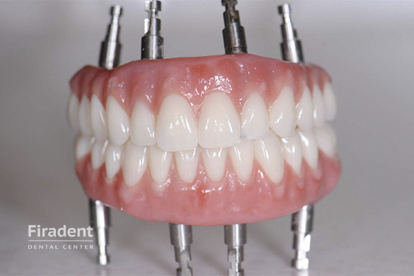 Имплантация зубов под ключ: виды, цены, отзывы