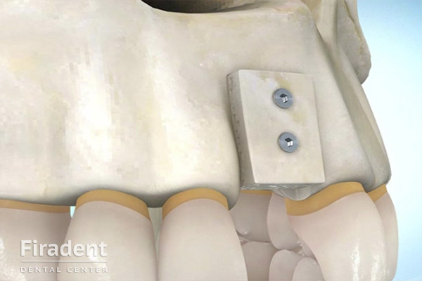 Аутотрасплантанты при имплантации зуба