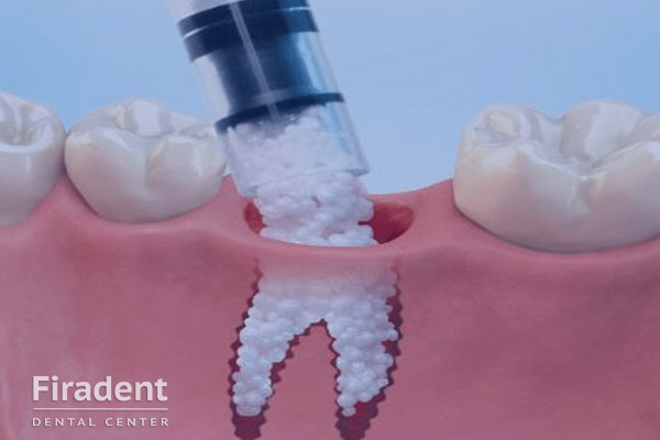 Аллогенные трансплантаты в стоматологии
