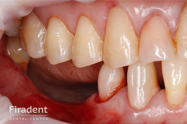 костная ткань возле зуба