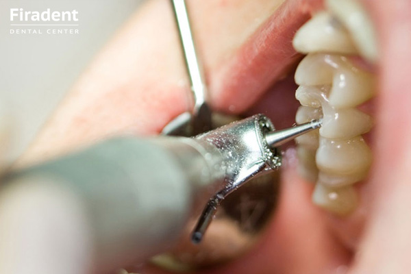 чистка и лечение зуба