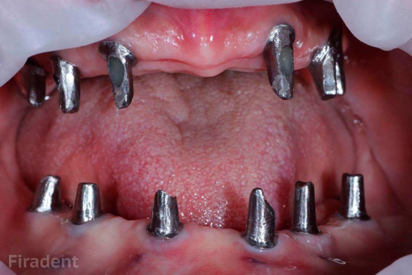 Имплантация Зубов Что Это Такое Фото