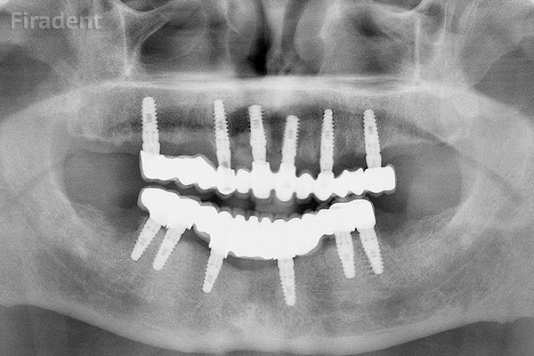 Полная имплантация зубов All-On-6