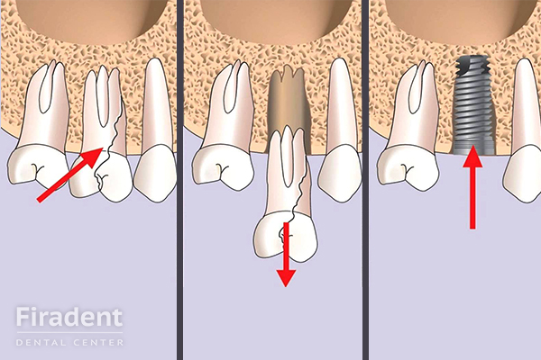 имплант после удаления зуба