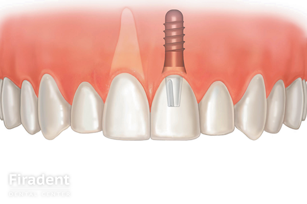 имплант на передний зуб