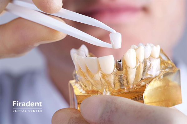 Поставить импланты зубов в Москве: как ставят импланты зубов, цены на услугу