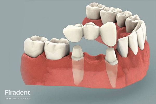 несъемное протезирование зубов