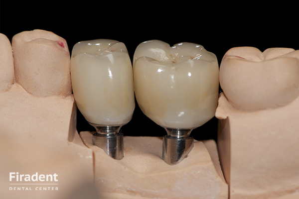 протезирование зубов на имплантах