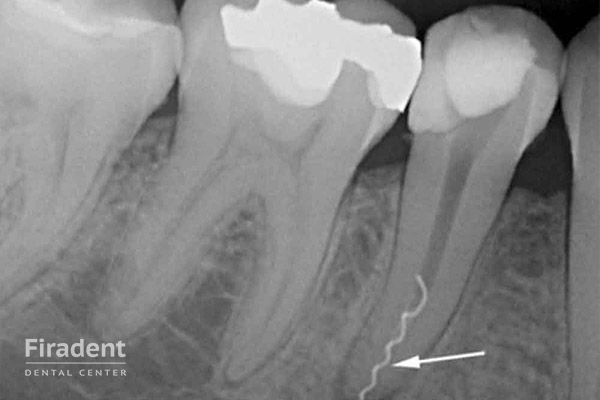 некачественное удаление нерва в зубе