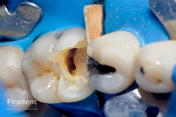удаление нерва в жевательном зубе