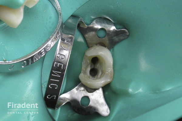 удаление нерва в зубе этап 3