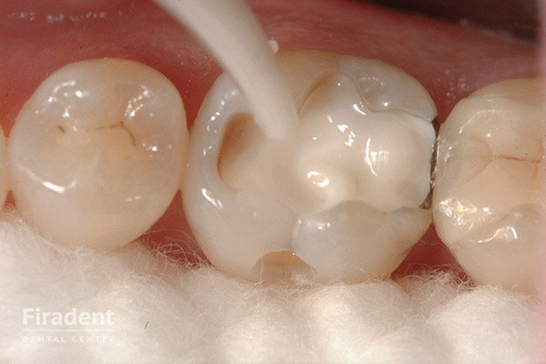удаление нерва в зубе этап 4