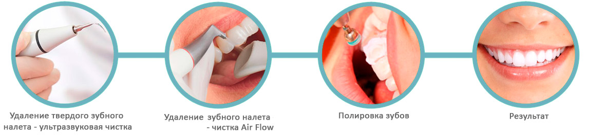 ультразвуковая чистка зубов этапы
